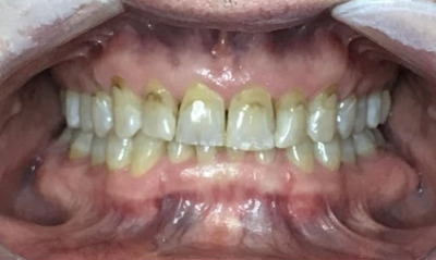 Before treatment - Invisalign, Whitening, & Bonding