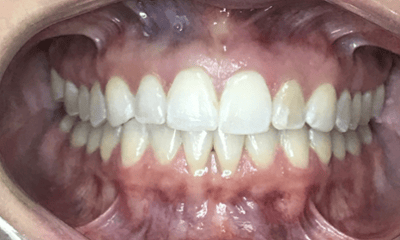 Before treatment - Invisalign & Whitening