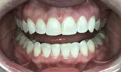 Before treatment - Invisalign & Whitening