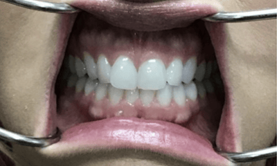Before treatment - Invisalign