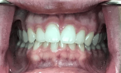Before treatment - Invisalign