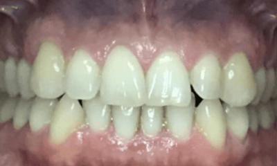 Before treatment - Invisalign