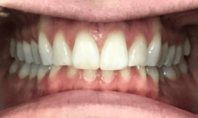 Before treatment - Invisalign