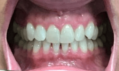 Before treatment - Invisalign