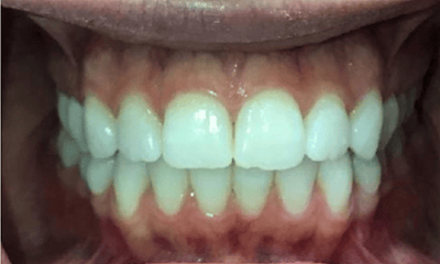 Before treatment - Invisalign