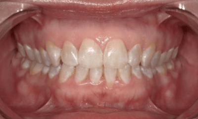 Before treatment - Invisalign