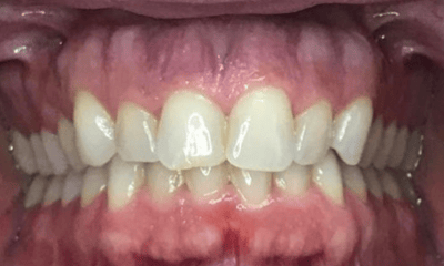 Before treatment - Invisalign