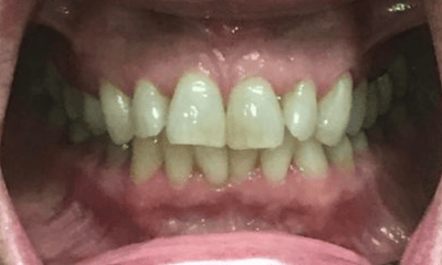 Before treatment - Invisalign