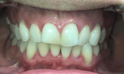 Before treatment - Invisalign & Anterior Bonding 