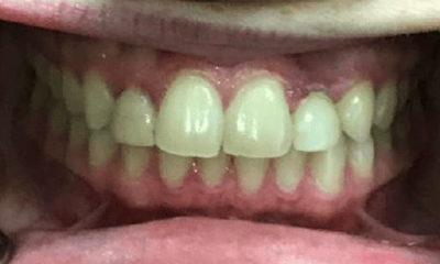 Before treatment - Invisalign