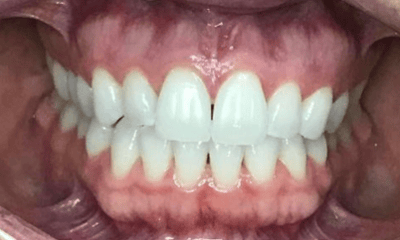 Before treatment - Invisalign