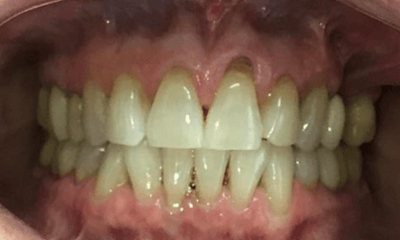 Before treatment - Invisalign