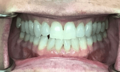 Before treatment - Invisalign
