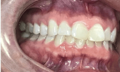 Before treatment - Invisalign