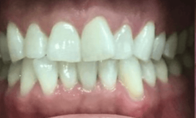 Before treatment - Invisalign