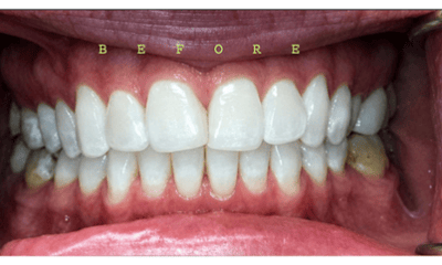 Before treatment - Invisalign