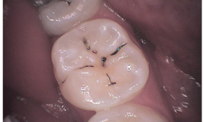 Before treatment - Lower Tooth Composite Fillings