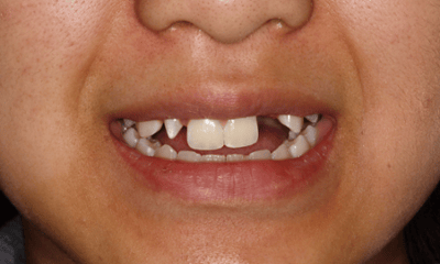 Before treatment - Temporary Maryland Bridge and Crown