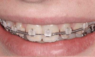 Before treatment - Peg Lateral Restoration