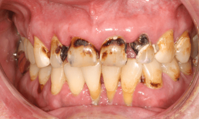 Before treatment - Crowns