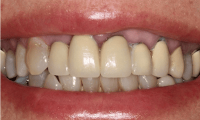 Before treatment - Smile Makeover Crown