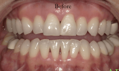 Before treatment - Veneers
