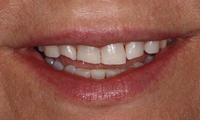 Before treatment - Smile Transformation