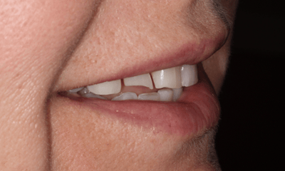 Before treatment - Smile Transformation 