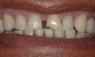 Before treatment - Trial Smile Makeover
