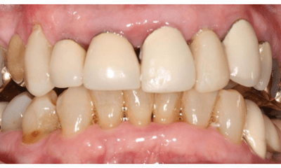 Before treatment - Upper Bridge Rehabilitation