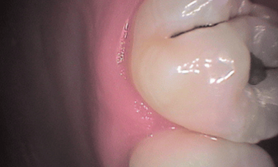 Before treatment - Upper Tooth Composite Fillings