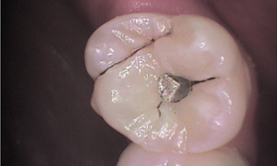 Before treatment - Upper Tooth Composite Fillings