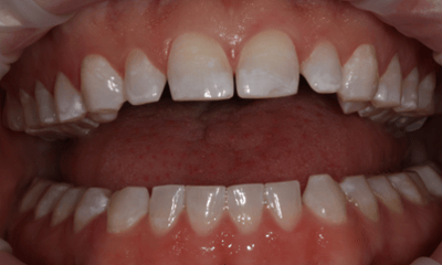 Before treatment - Whitening
