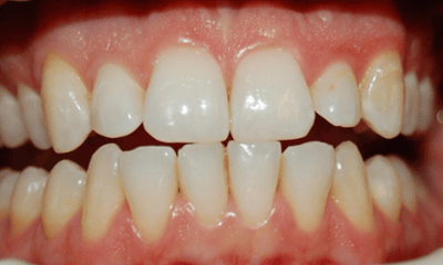 Before treatment - Whitening