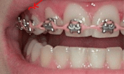 Before treatment - Veneers