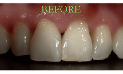 Before treatment - Veneers