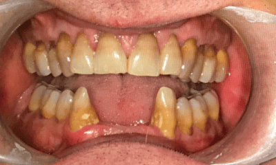 Before treatment - Lower Implant Bridge