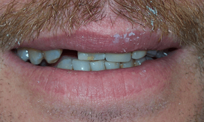 Before treatment - Crowns & Implant 