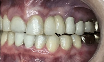 Before treatment - Invisalign & Crown