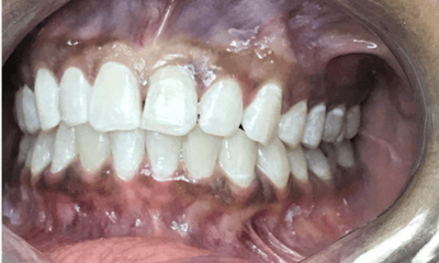 Before treatment - Invisalign Black Triangle