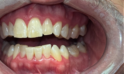 Before treatment - Invisalign & Bonding