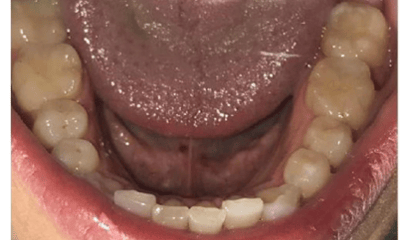 Before treatment - Invisalign Crowding & Single Tooth Crossbite