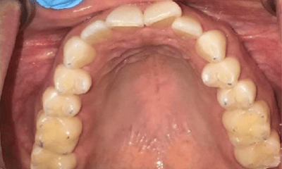 Before treatment - Invisalign Crowding
