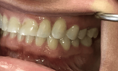 Before treatment - Invisalign & Crowns Combo
