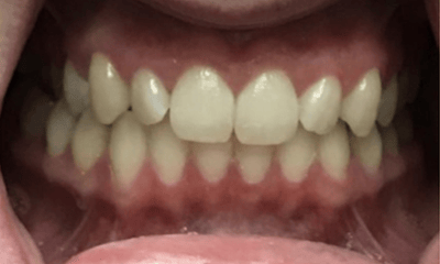 Before treatment - Invisalign Rotation Crossbite