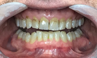 Before treatment - Invisalign, Whitening, & Bonding