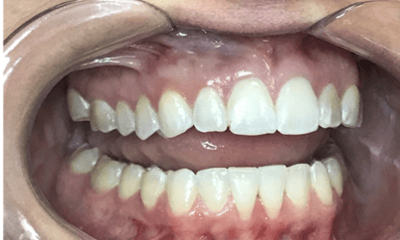 Before treatment - Invisalign & Whitening