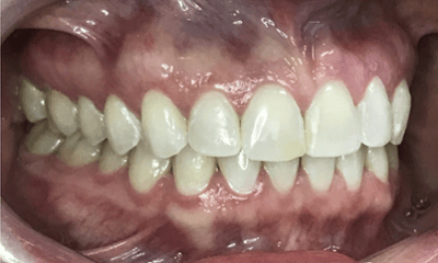 Before treatment - Invisalign & Whitening