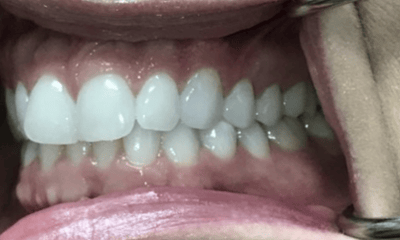 Before treatment - Invisalign