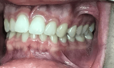 Before treatment - Invisalign